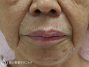 症例写真 術前 プレミアムPRP皮膚再生療法