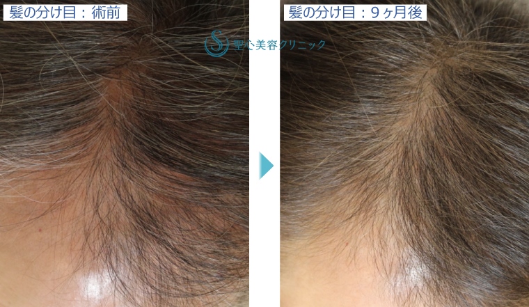 症例写真 術前術後比較 グロースファクター再生療法 髪の分け目