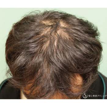 症例写真 術前 毛髪再生療法 KIPスカルプヘアエッセンス