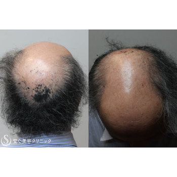 症例写真 術前 毛髪再生療法 グロースファクター再生療法
