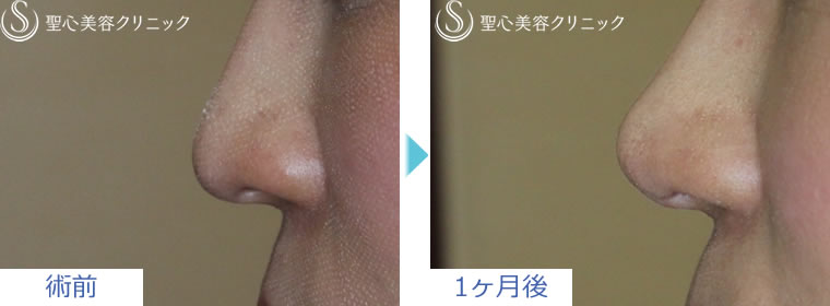 症例写真　術前術後　鼻の整形