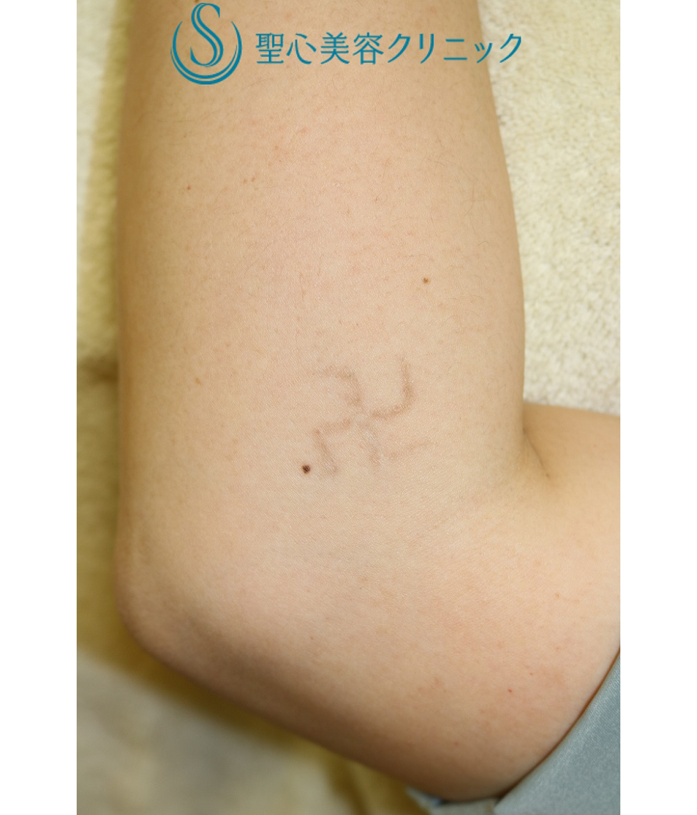 症例写真 術後 刺青・タトゥー除去（手術/レーザー治療）