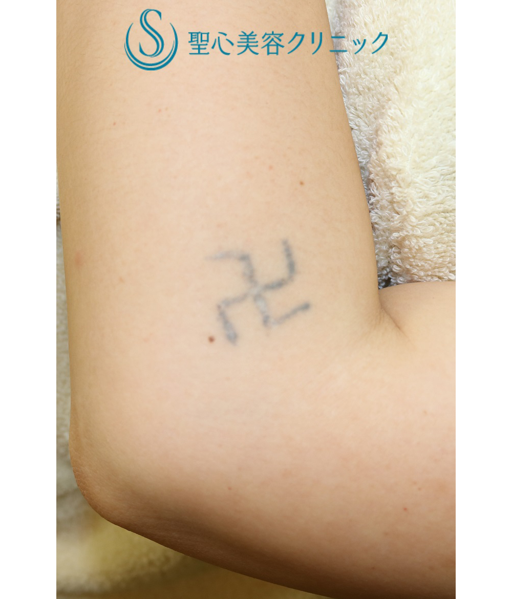 症例写真 術前 刺青・タトゥー除去（手術/レーザー治療）