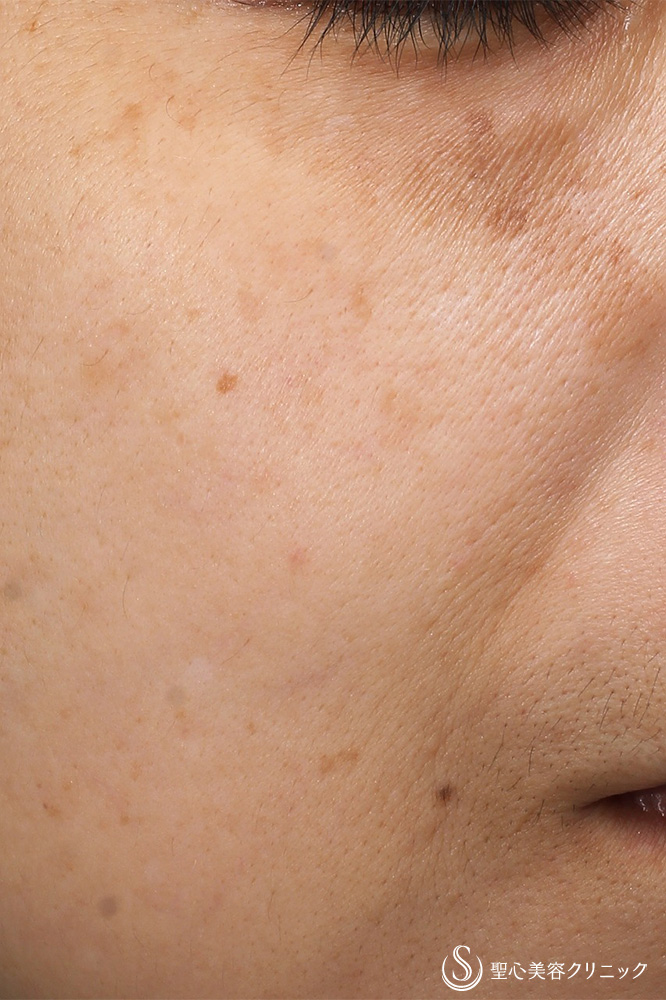  N-トレチノインシリーズ＋ステムサイエンスM.D.＋トラネキサム酸処方_After