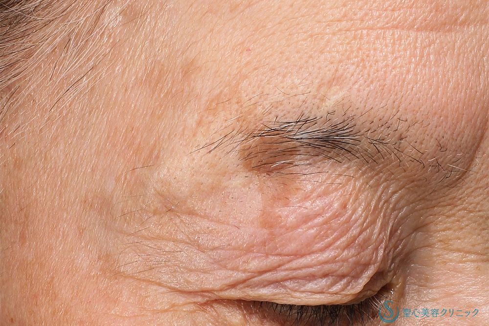 シミレーザー_Before