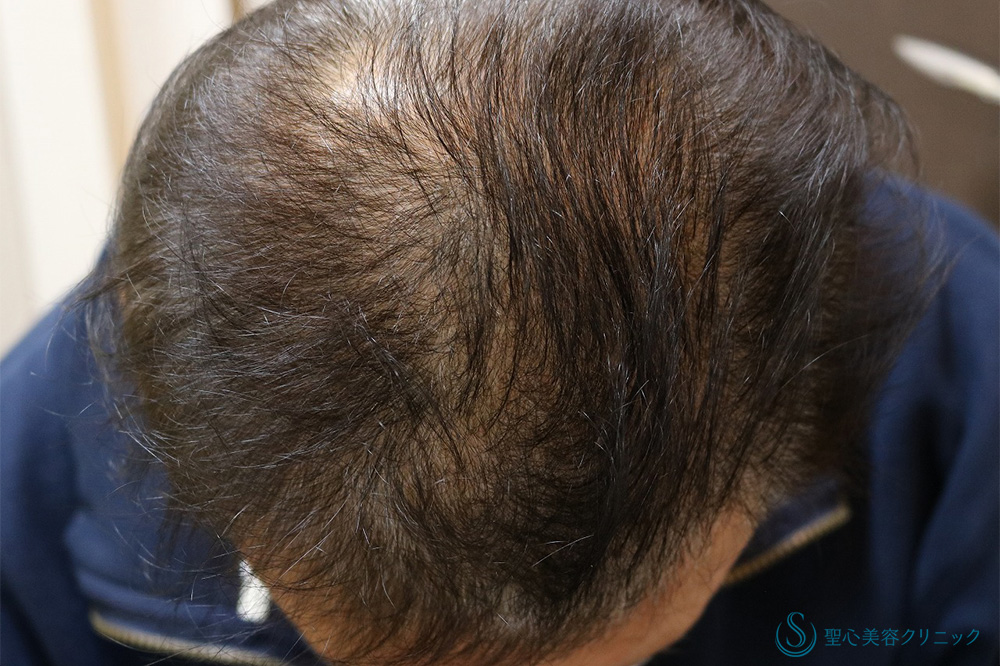 プレミアムグロースファクター再生療法_After