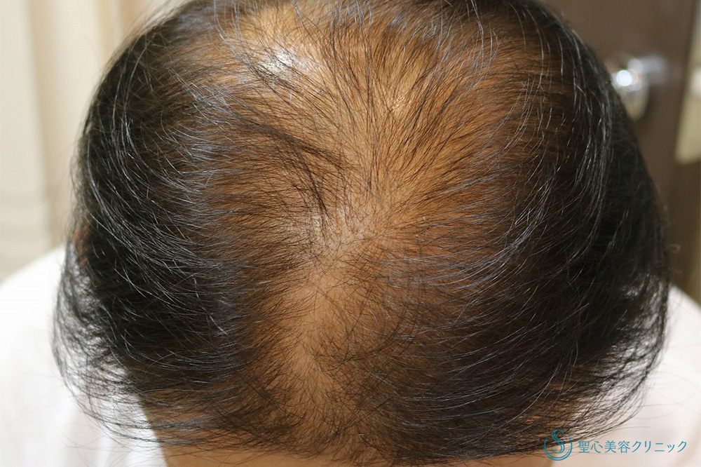 プレミアムグロースファクター再生療法_Before