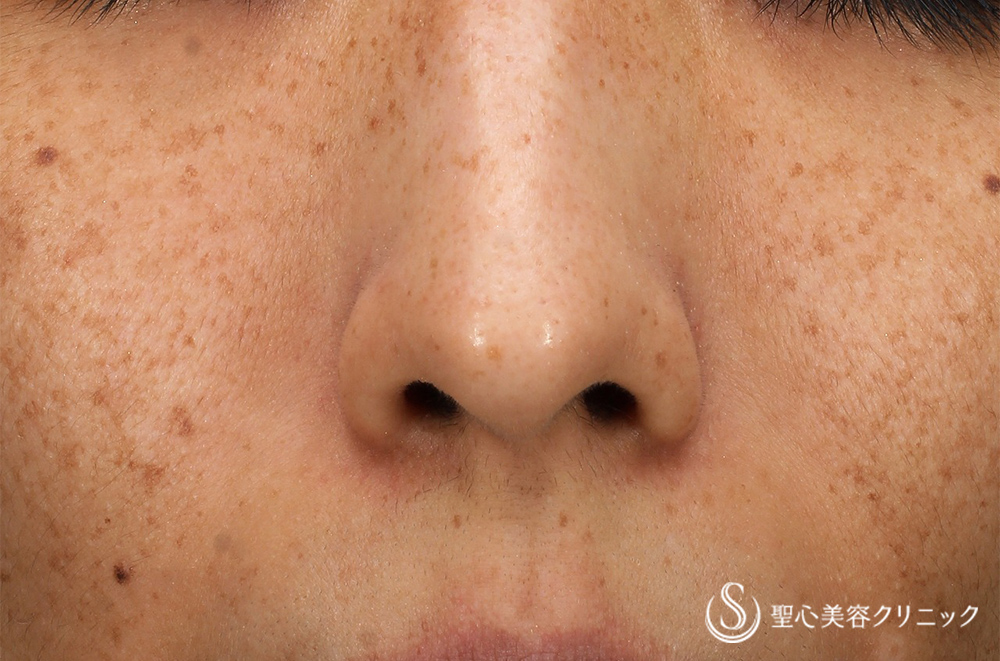 CellecV（セレックV）_Before