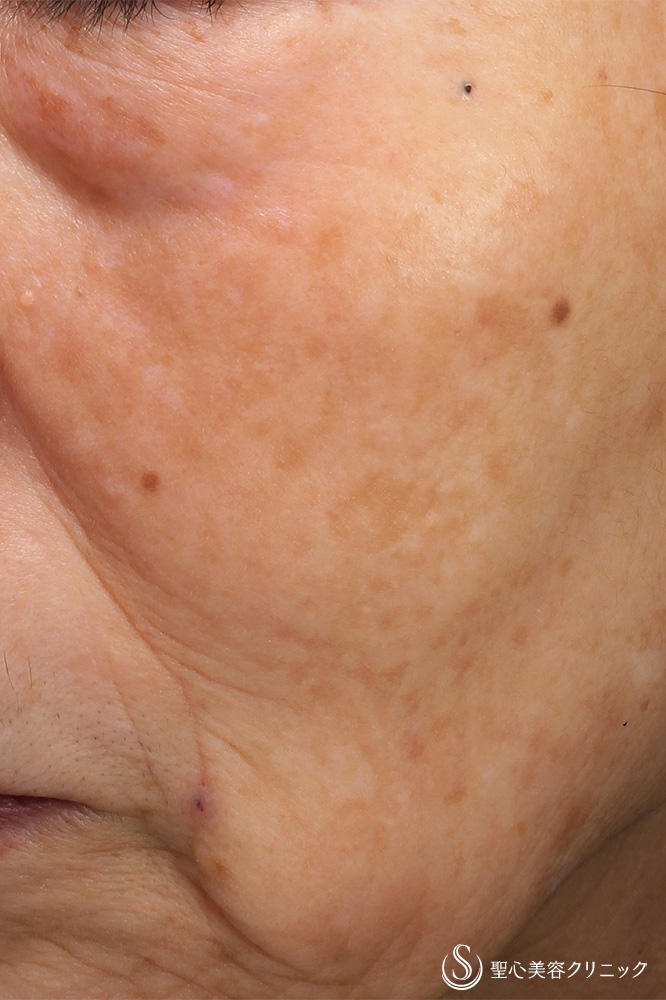 CellecV（セレックV）_After