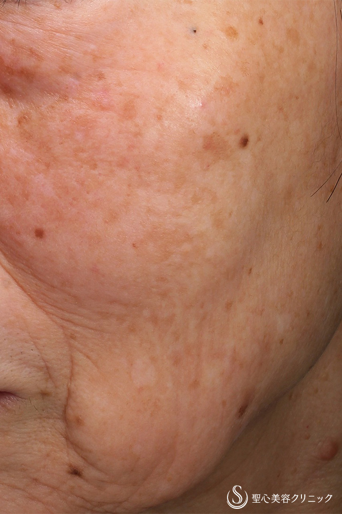 CellecV（セレックV）_Before