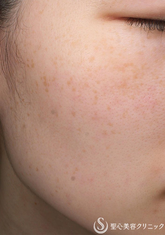 QスイッチYAGレーザー_Before