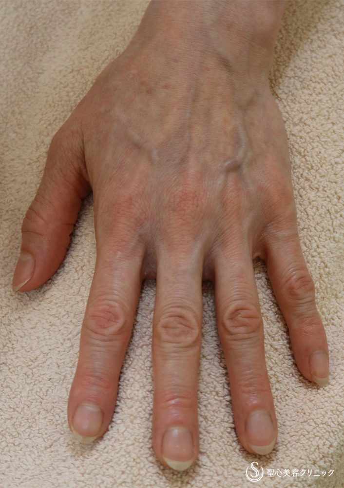 プレミアムPRP皮膚再生療法_Before