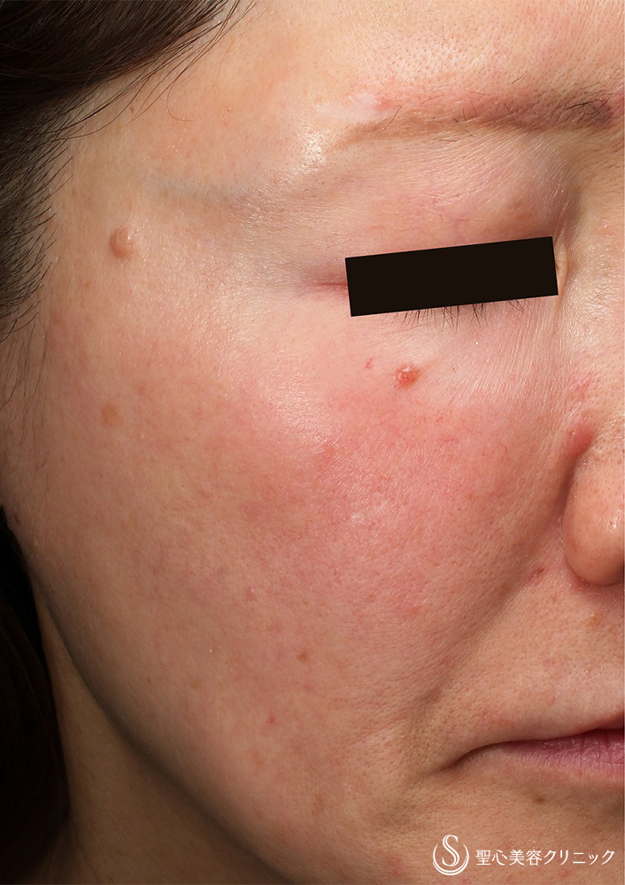 ダーマセプト（ローション＋クリーム）_After