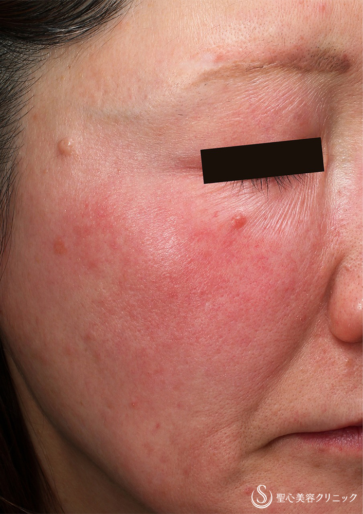 ダーマセプト（ローション＋クリーム）_Before