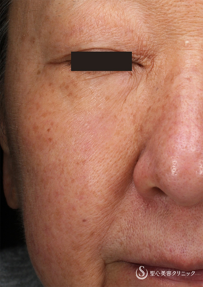 シミレーザー（トライビーム）_After