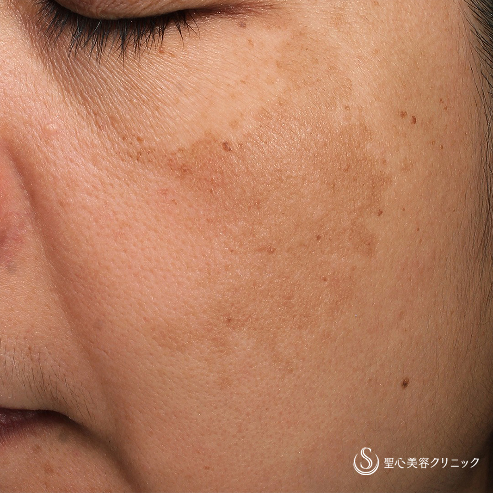 トラネキサム酸内服のみ_Before