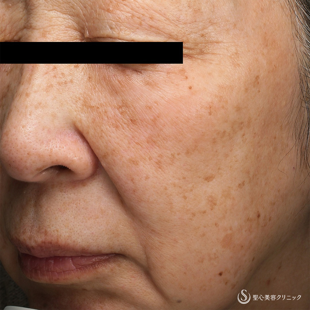 QスイッチYAGレーザー_After