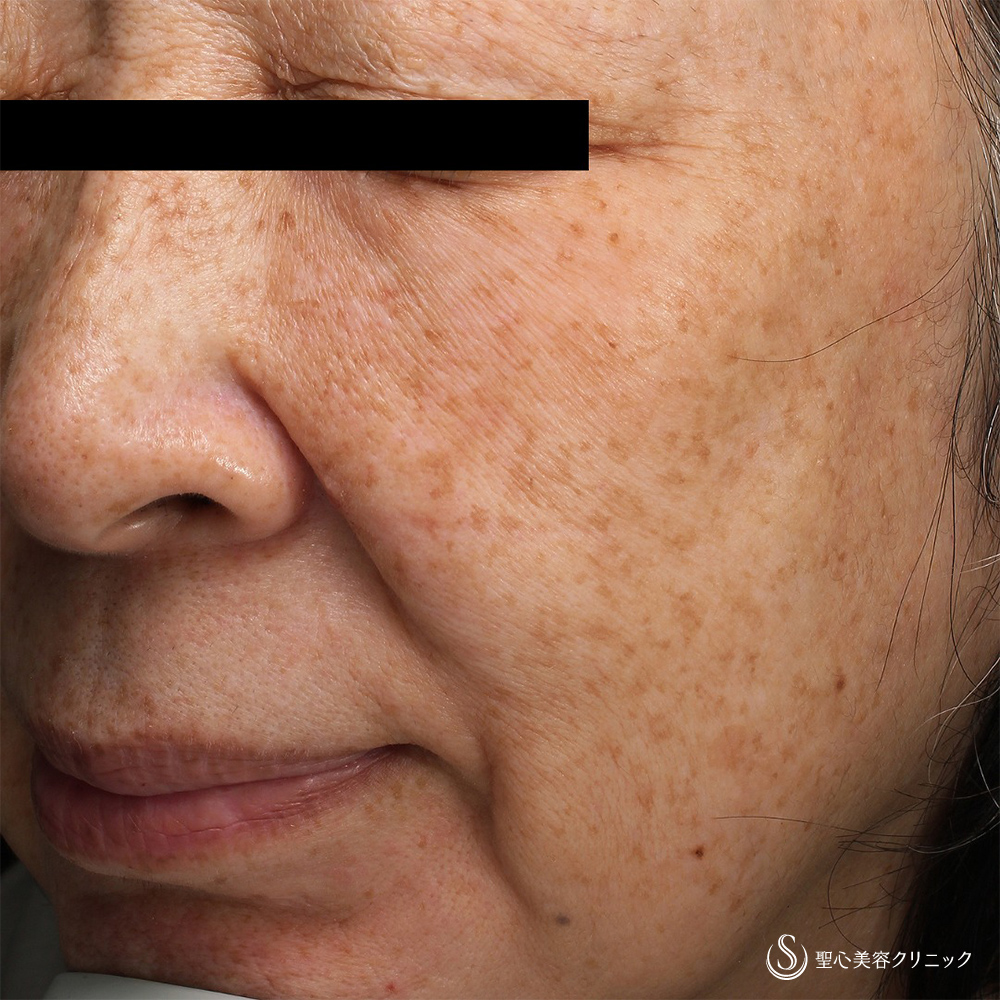 QスイッチYAGレーザー_Before