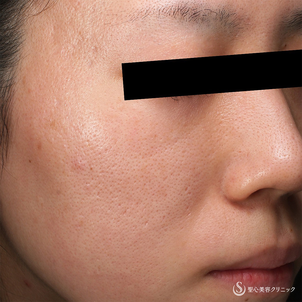 ダーマペン4_After