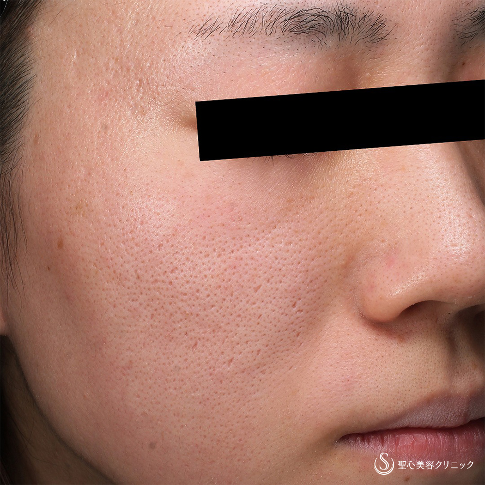 ダーマペン4_Before