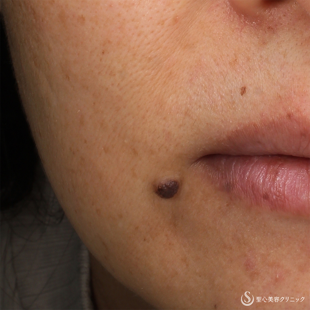 ホクロ除去_Before