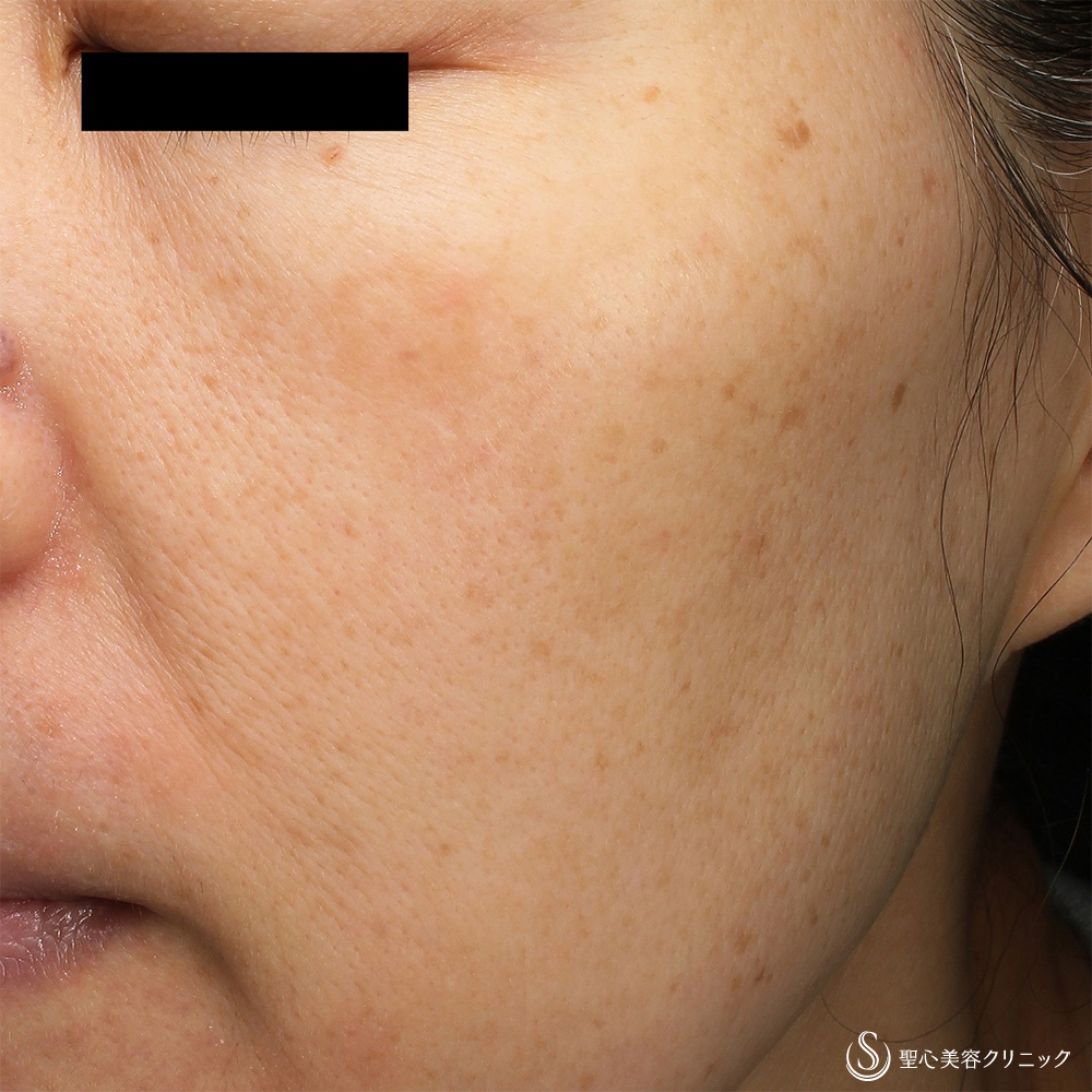 CellecV（セレックV）_After