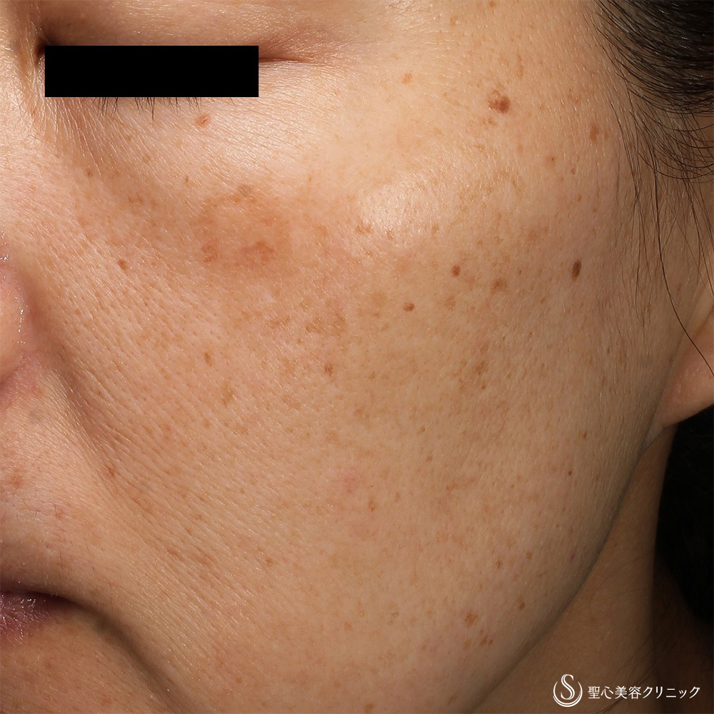 CellecV（セレックV）_Before