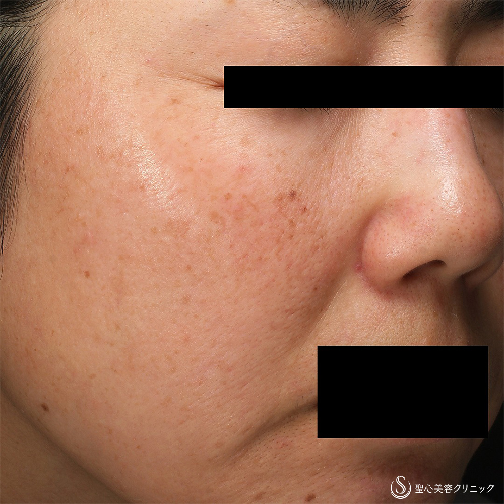 CellecV（セレックV）_Before