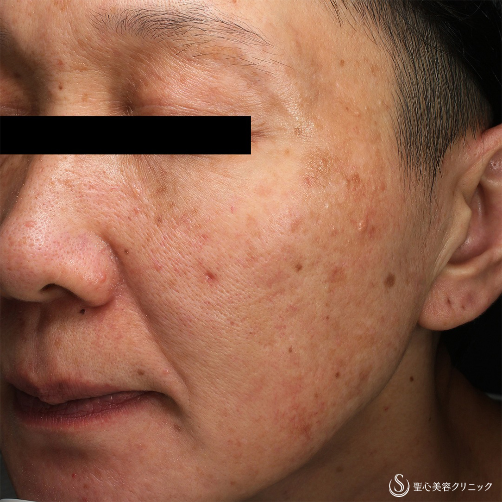 CellecV（セレックV）_After