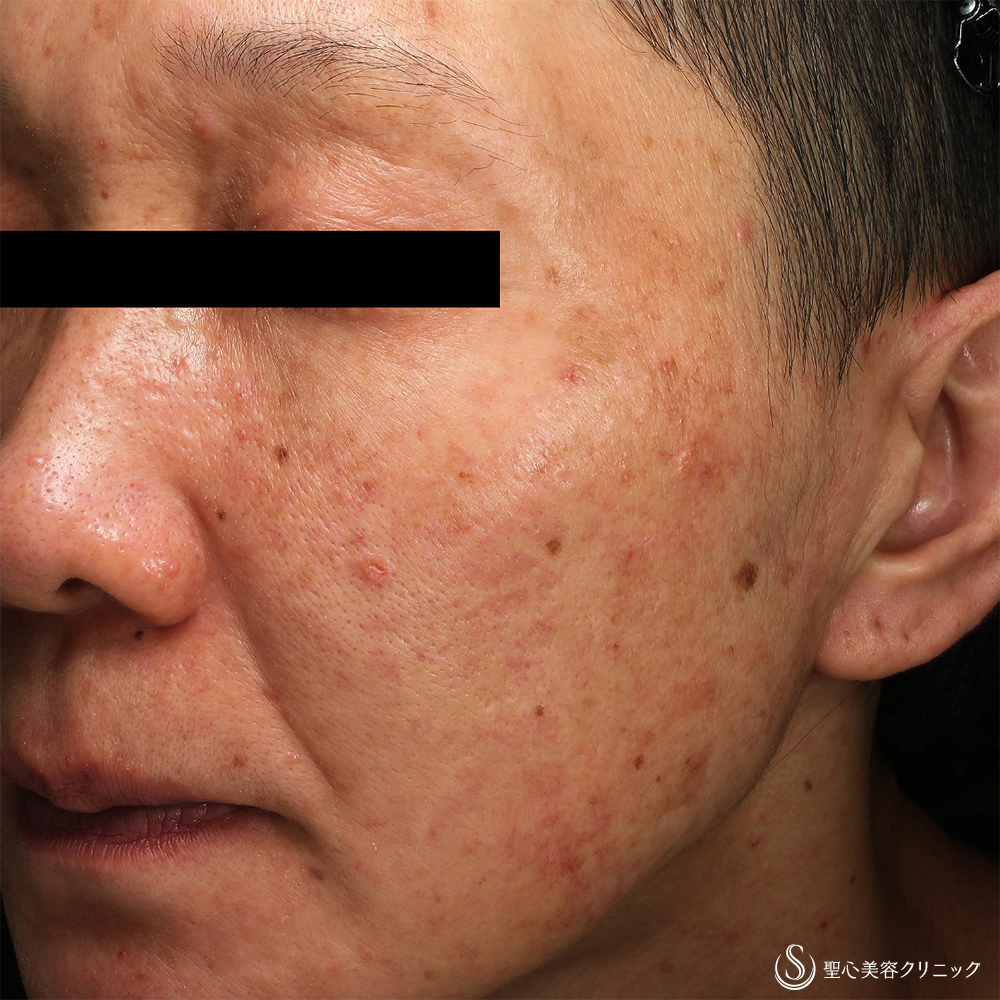 CellecV（セレックV）_Before