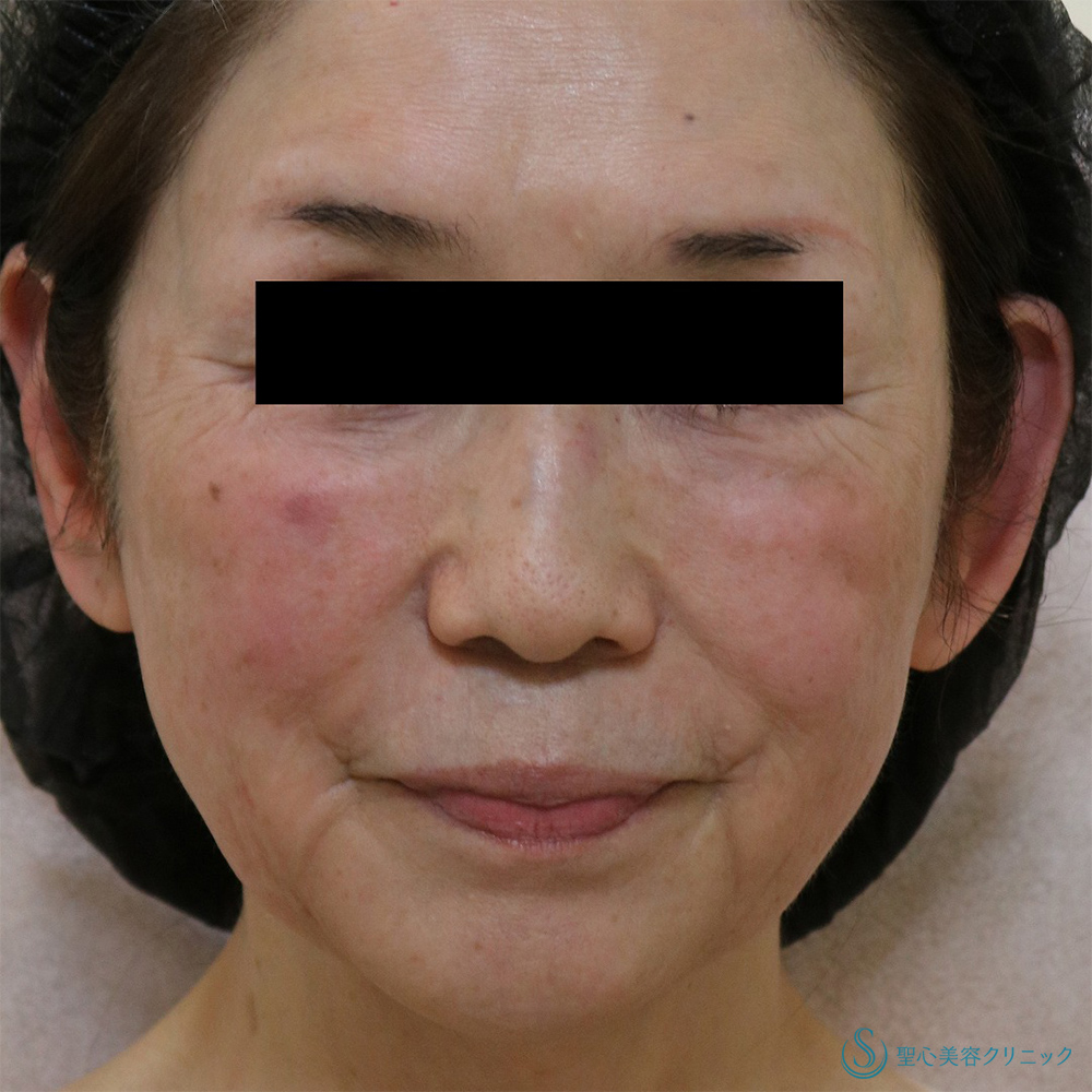 ドクターDENSITY（デンシティ）_After