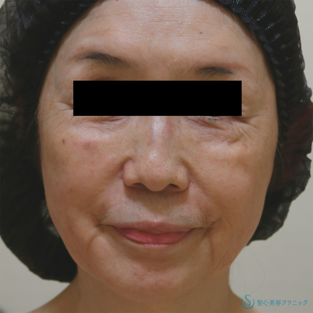 ドクターDENSITY（デンシティ）_Before