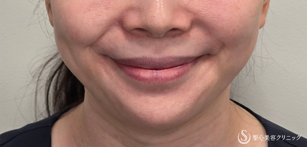 小鼻ボツリヌストキシン注入_Before