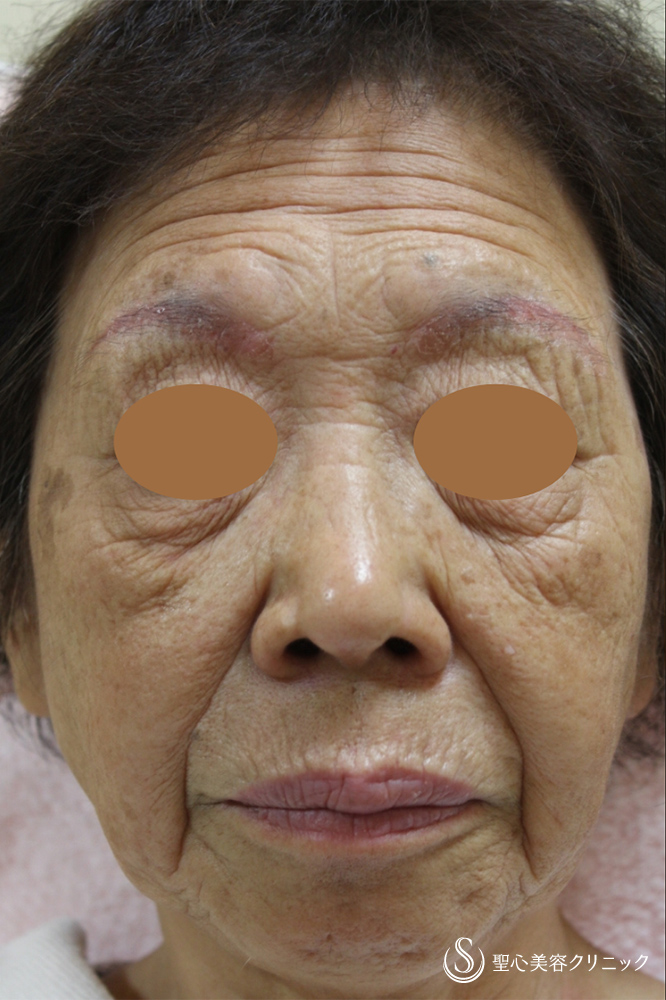 プレミアムPRP皮膚再生療法_Before