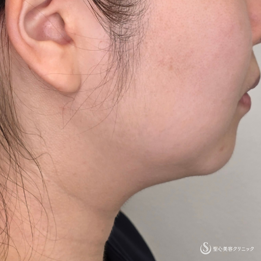 ドクターハイフ（ウルトラセルQプラス）_After