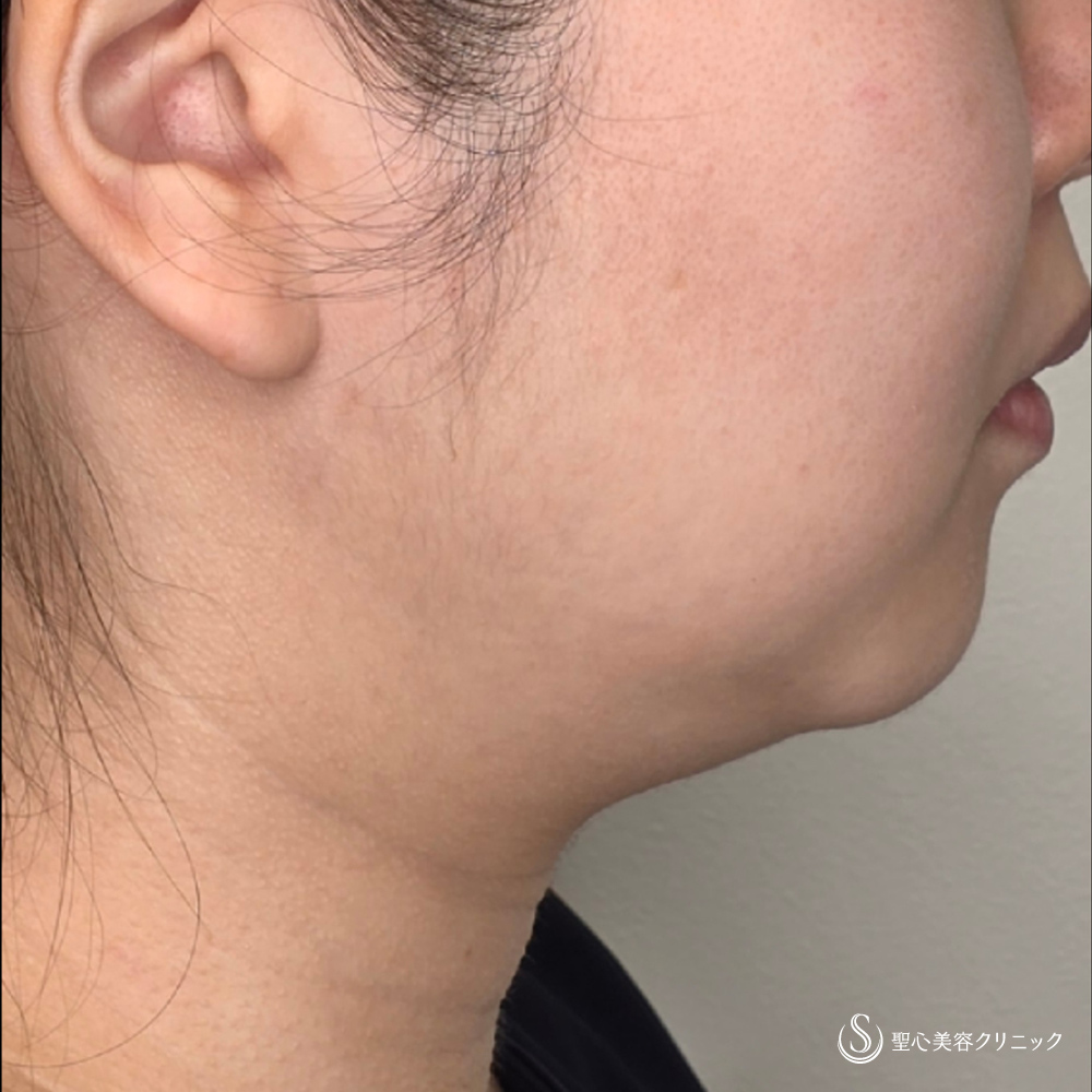 ドクターハイフ（ウルトラセルQプラス）_Before