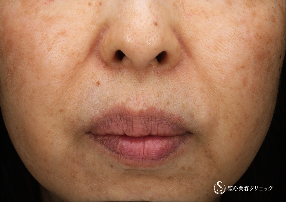 プレミアムPRP皮膚再生療法_After