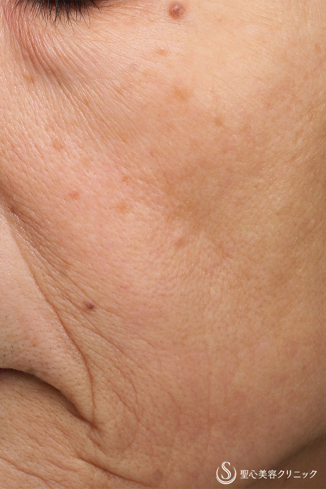 CellecV（セレックV）_After