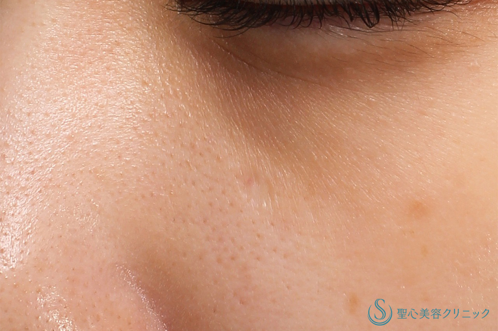 電気凝固法（ホクロ・イボ）_After