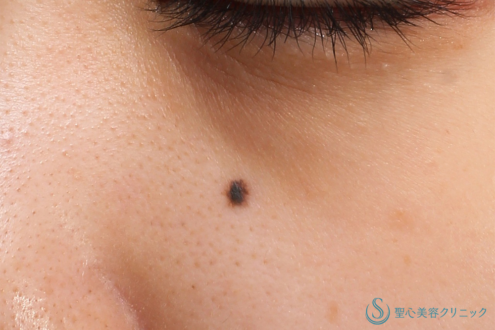 電気凝固法（ホクロ・イボ）_Before