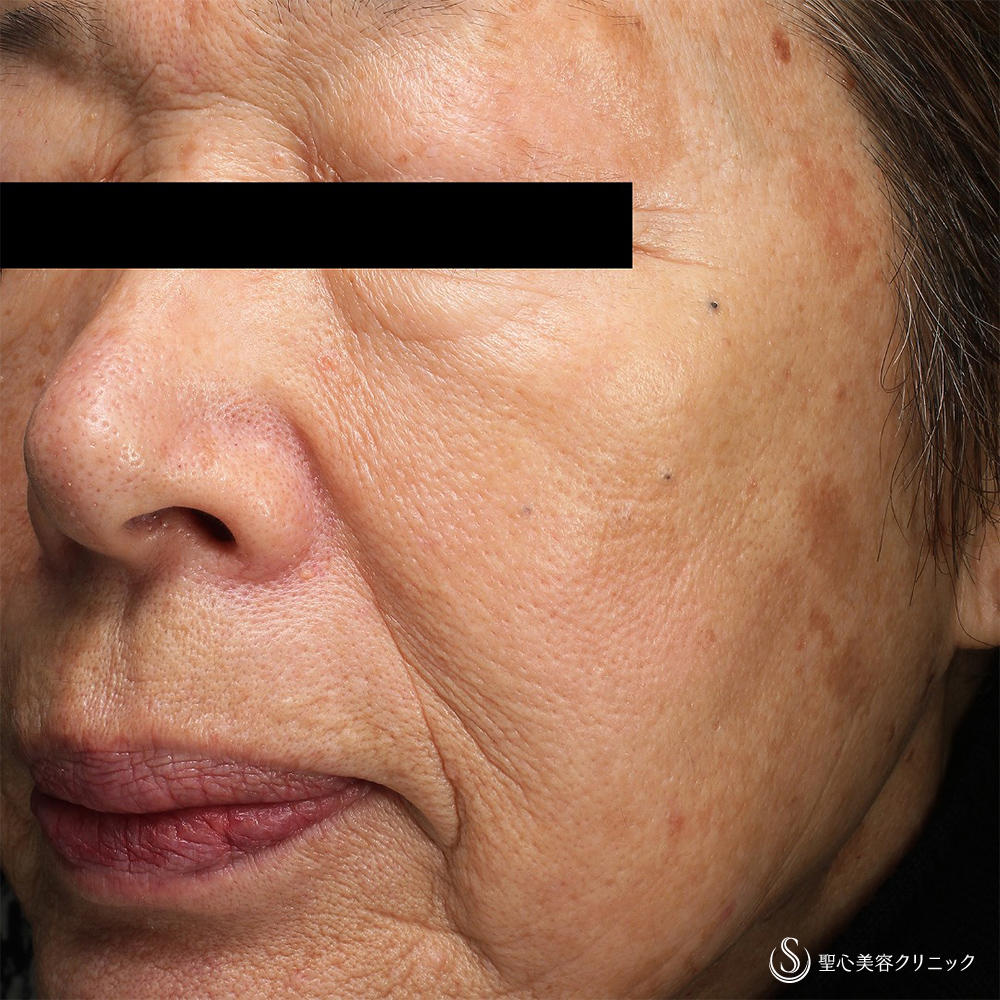 CellecV（セレックV）_After