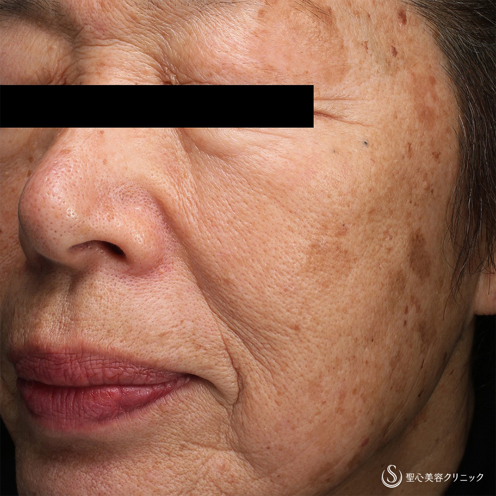 CellecV（セレックV）_Before