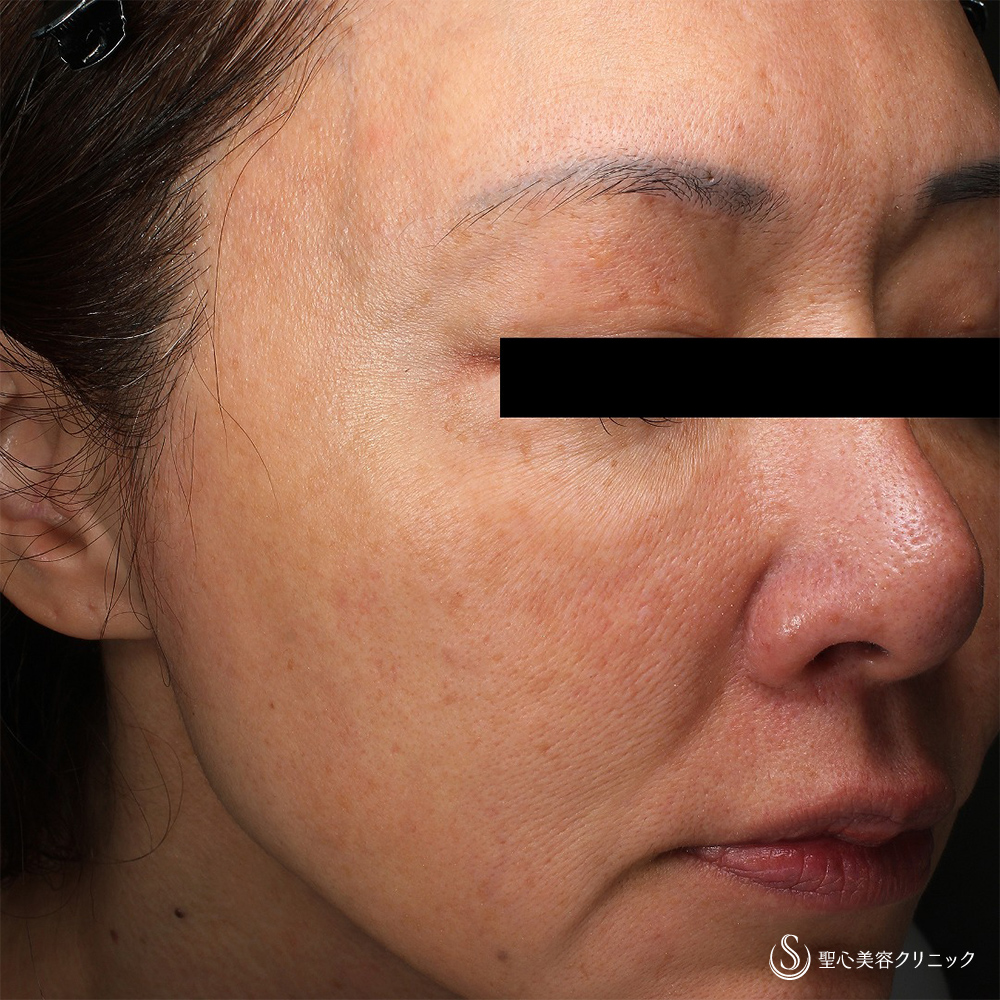 水光注射_Before