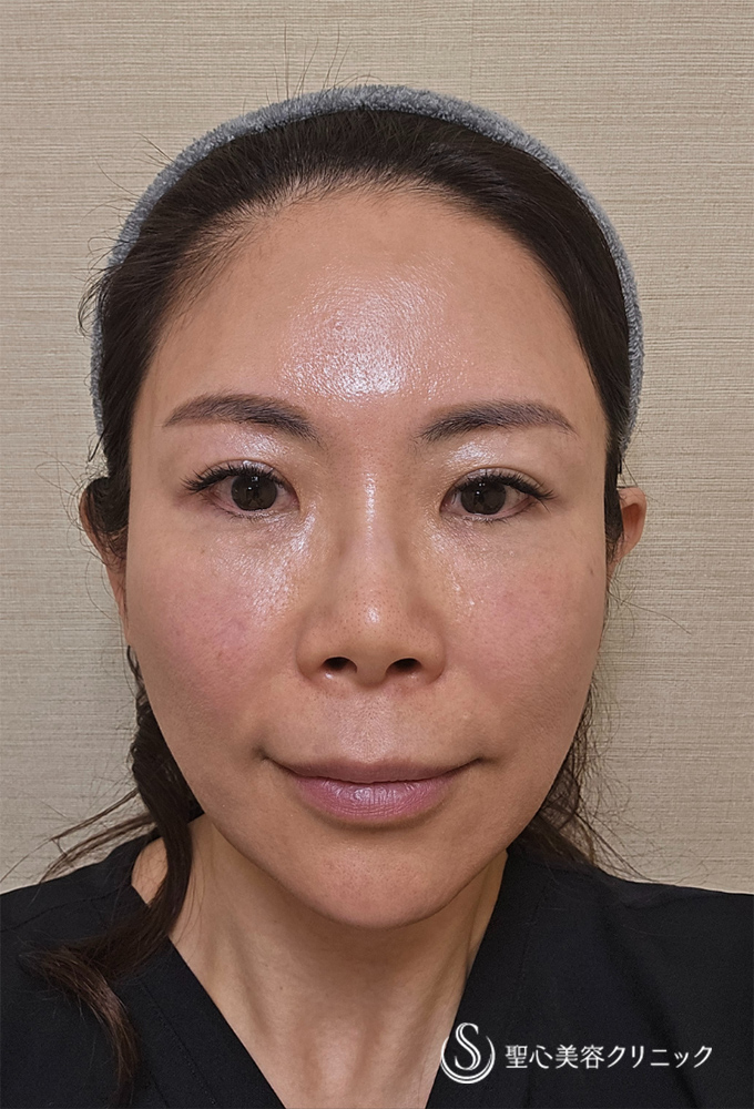 ドクターDENSITY（デンシティ）_After