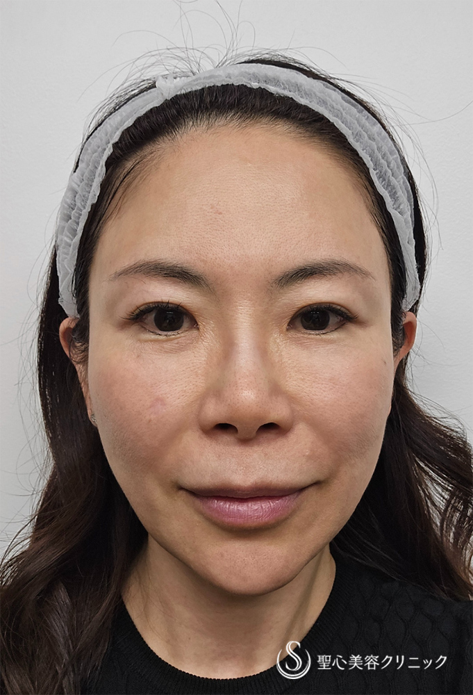 ドクターDENSITY（デンシティ）_Before