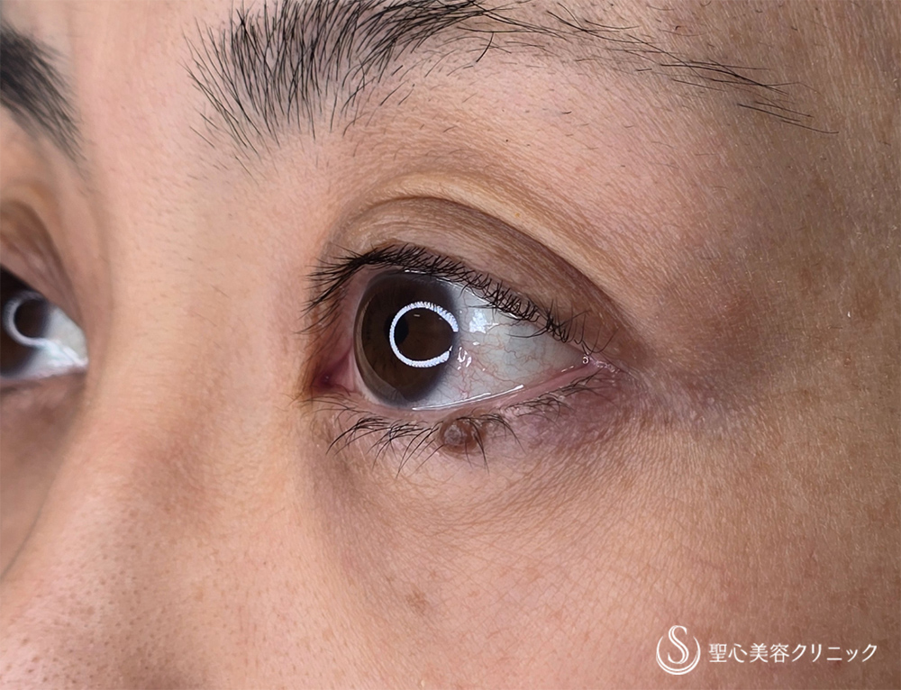 ホクロ除去_Before